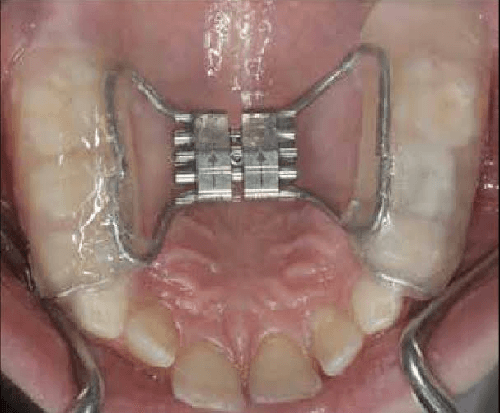 Rapid Maxillary Expansion