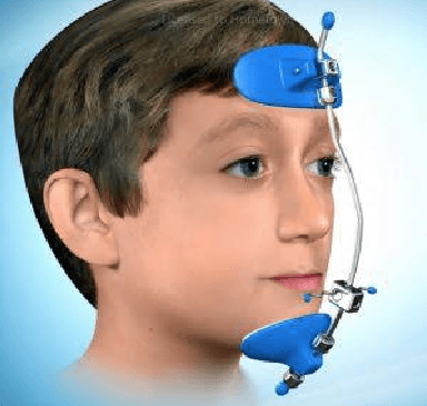 Myofunctional Treatment