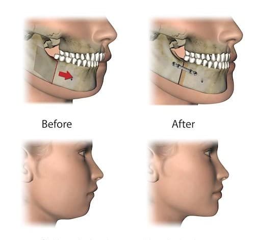 Orthognathic Surgery